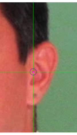 Tragion marking on a photograph in oblique view (right)