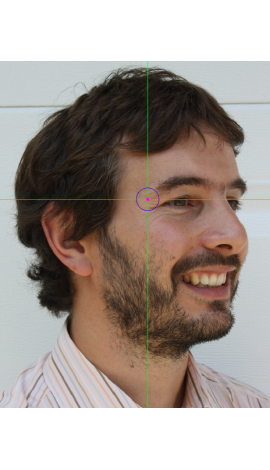 Marcado de frontozygomaticus en una fotografía en vista oblicua (derecha)