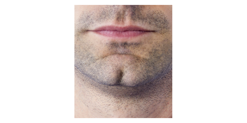 Subject with cleft chin