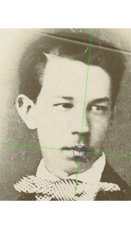 Stomion marking on a photograph in oblique view (right)