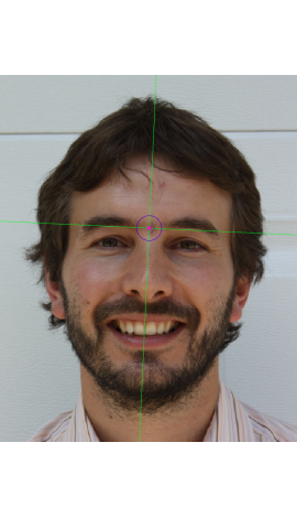 Nasion marking on a photograph in frontal view (left)