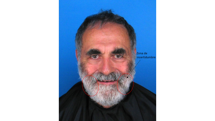 Sujeto con barba que oculta el contorno facial, imposibilitando la localización de ambos gonion