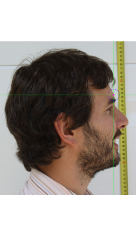 Glabella marking on a photograph in lateral view (center)