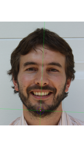 Gnathion marking on a photograph in frontal view (left)