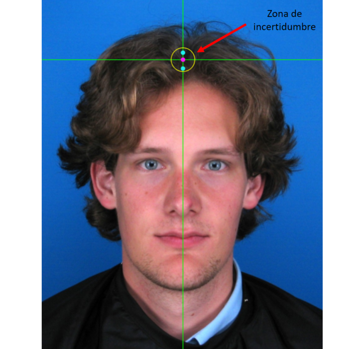 Zona de incertidumbre para el marcado de vertex en sujetos con cabello