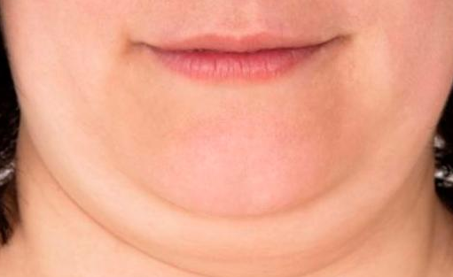 Parte inferior de la cara con acumulación de tejido adiposo que dificulta la observación del contorno facial