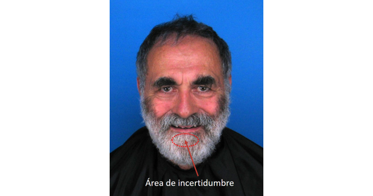 Sujeto con barba poblada que imposibilita la visión del surco mentolabial