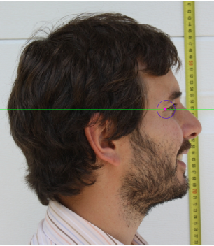 Lateral view image (right profile). The landmarks in the left profile cannot be estimated