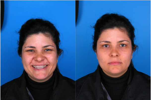 Example of the distortion caused by facial expression, same subject smiling (left) and with a neutral expression (right)