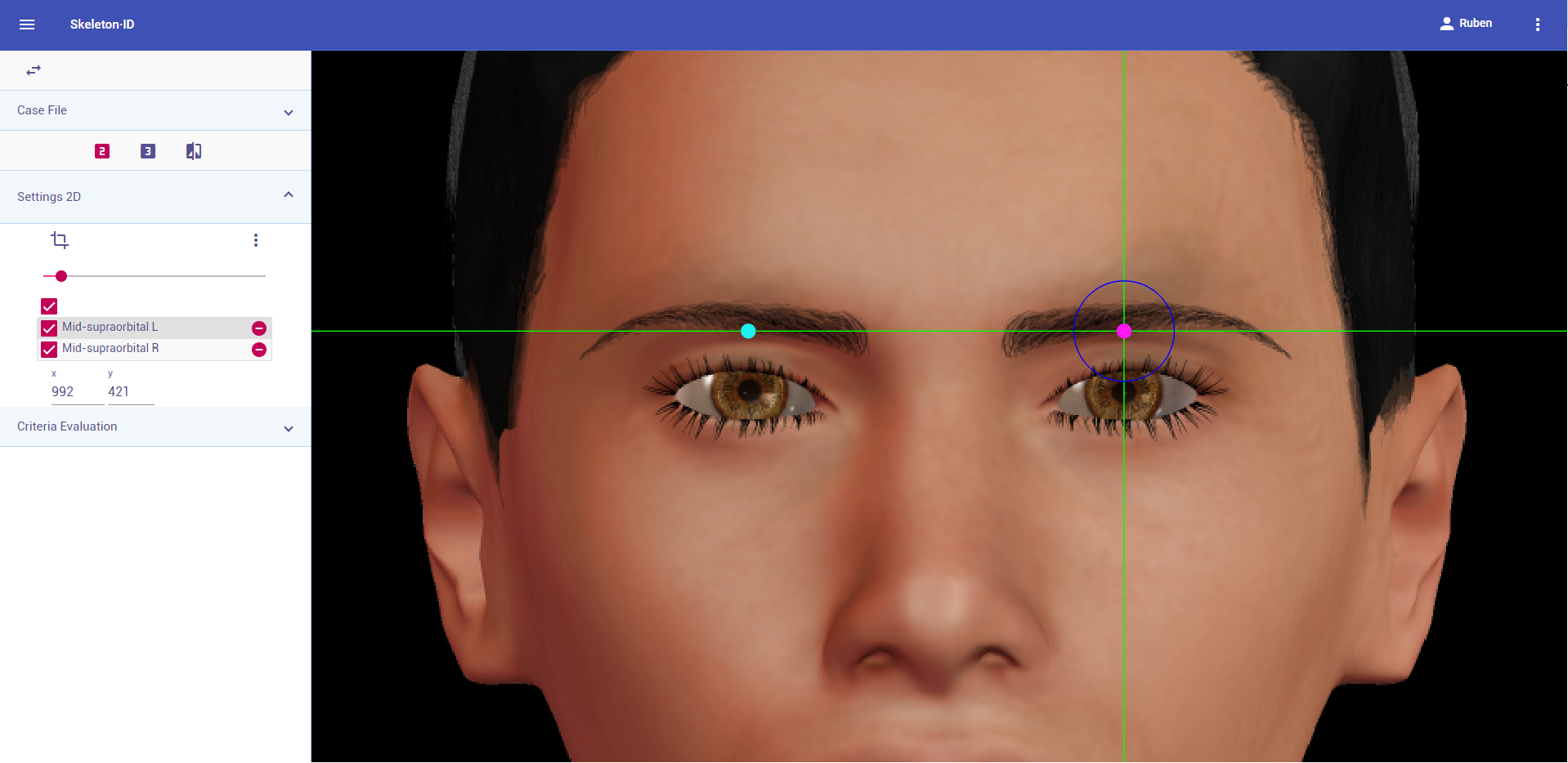 Mid-supraorbital (left and right) in frontal view. Approximation in the image