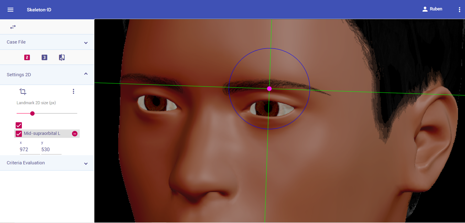 Mid-supraorbital (izquierdo) en vista oblicua. Aproximación en la imagen