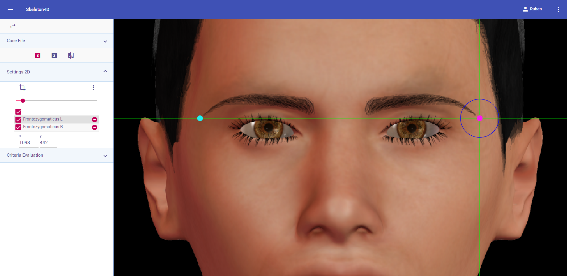 Frontozygomaticus (left and right) in frontal view. Approximation in the image