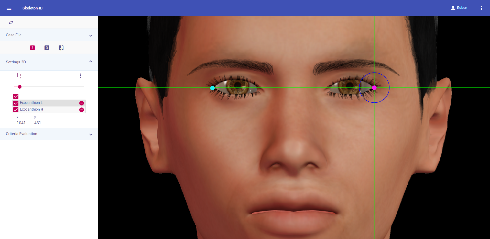 Exocanthion (izquierdo y derecho) en vista frontal. Aproximación en la imagen