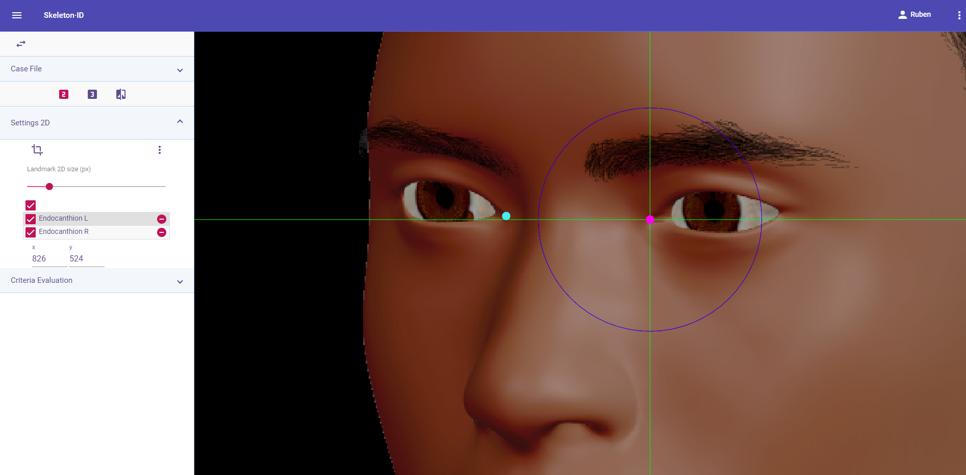 Endocanthion (left) in oblique view. Approximation in the image