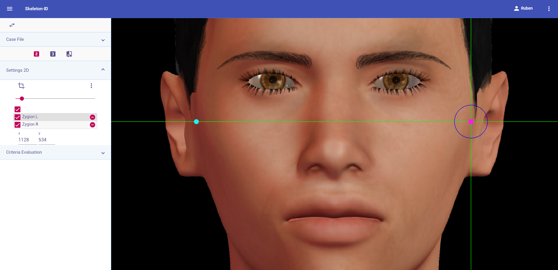 Zygion (left and right) in frontal view. Approximation in the image