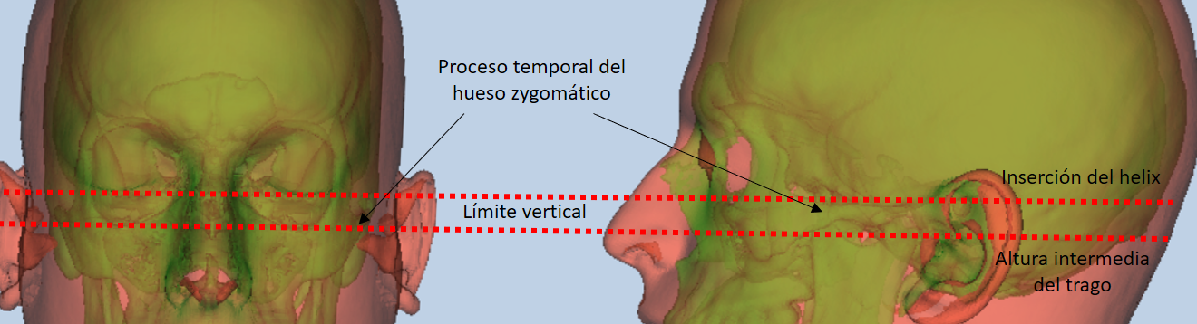 Zona de estimación de zygion en la cara