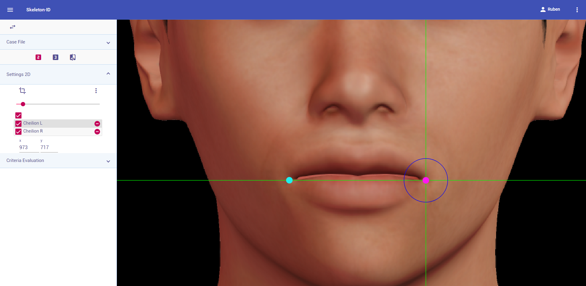 Cheilion (left and right) in frontal view. Approximation in the image