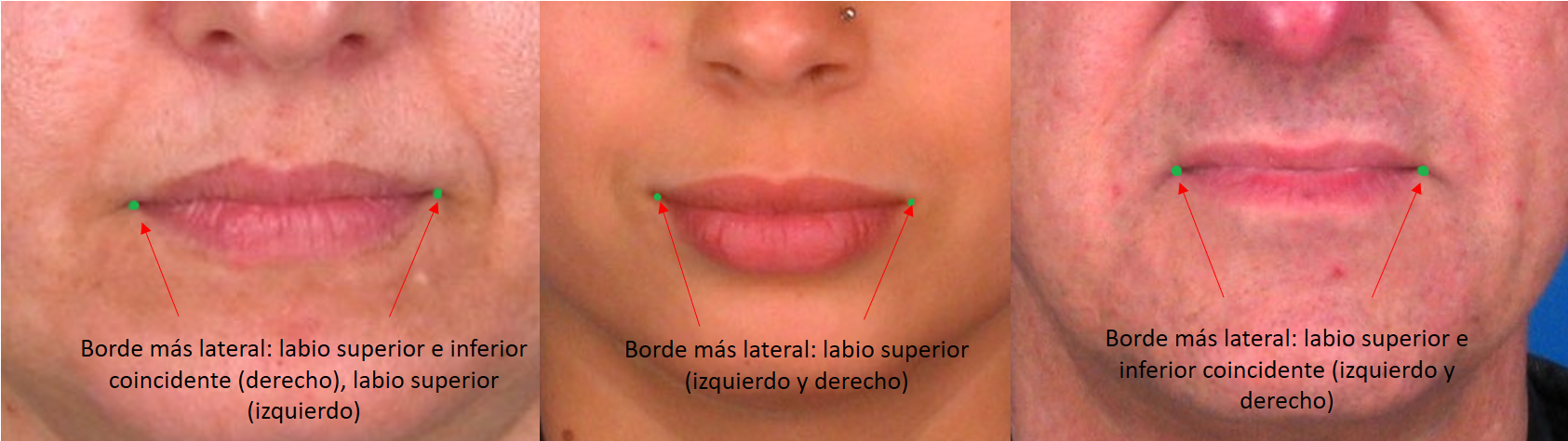 Ejemplos de distintos puntos de unión del labio superior e inferior en la rima oris
