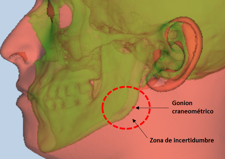 Gonion craneométrico y área de incertidumbre del tejido blando